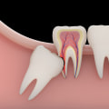 Reasons You May Need Your Wisdom Teeth Extracted