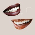 Maintaining Your Veneers: Tips and Tricks for Long-Lasting Results