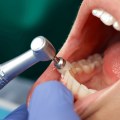 The Importance of Professional Teeth Cleaning