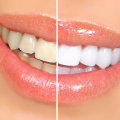 A Brighter Smile: Understanding In-Office Whitening Treatments