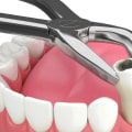 Understanding Tooth Extractions: Reasons for the Procedure