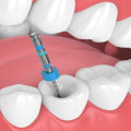 Understanding Aftercare for a Root Canal Procedure
