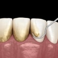 Treatment Options for Gum Disease: What You Need to Know