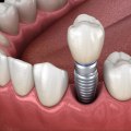 A Step-by-Step Guide to Getting Dental Implants