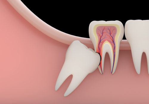 Reasons You May Need Your Wisdom Teeth Extracted