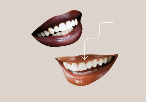 Maintaining Your Veneers: Tips and Tricks for Long-Lasting Results