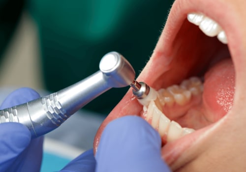 The Importance of Professional Teeth Cleaning