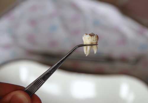 Exploring the Procedure for Wisdom Tooth Extraction