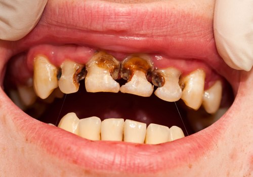 Understanding Tooth Decay and Cavities: Causes and Treatment