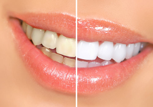 A Brighter Smile: Understanding In-Office Whitening Treatments
