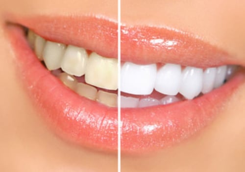 Natural Remedies for Teeth Whitening: A Comprehensive Guide to a Brighter Smile