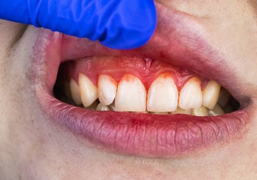 Understanding Gum Disease: Types, Causes, and Treatment