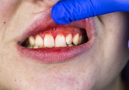 Symptoms and Risk Factors of Gum Disease: Everything You Need to Know