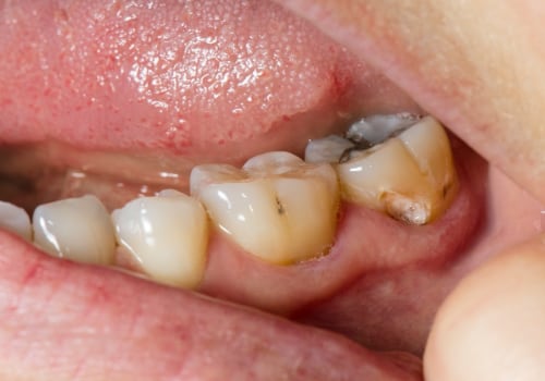 Understanding Symptoms and Diagnosis for Tooth Decay and Cavities